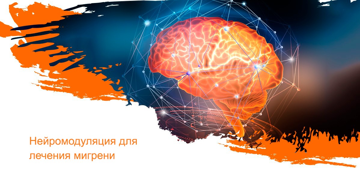 Нейромодуляция для лечения мигрени